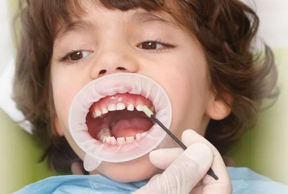 Fluoride Application