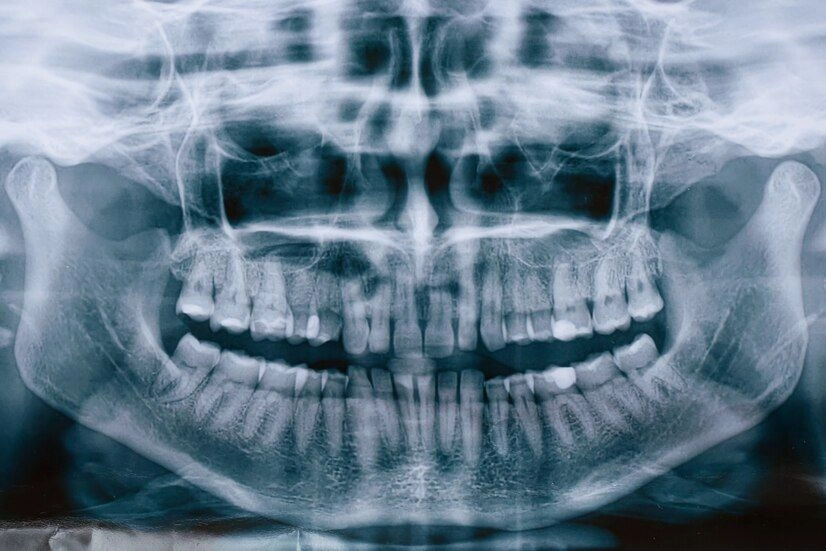 Dental X-ray